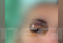 Άγριος ξυλοδαρμός 25χρονης από τον σύντροφό της: Την τράβηξε από τα μαλλιά και της μαύρισε το μάτι – «Δεν με άφηνε να φύγω»